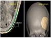 시지바이오, 3D 임플란트 ‘이지메이드-CF’ 활용 두개골 성형수술 성공