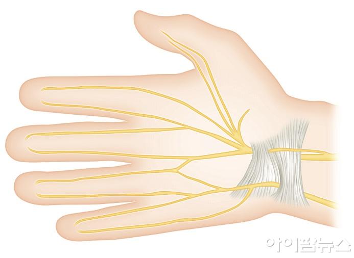 악수와 같은 반복적인 손목 사용은 손목터널증후군을 유발할 수 있다.jpg