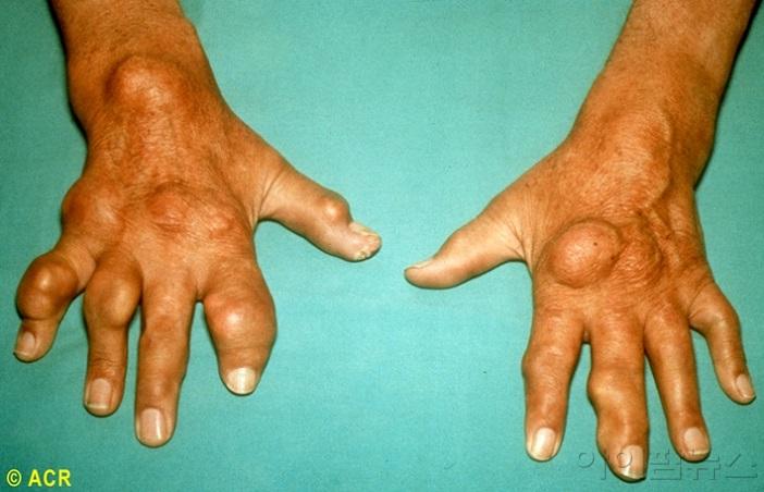 만성결절 통풍환자의 손.jpg