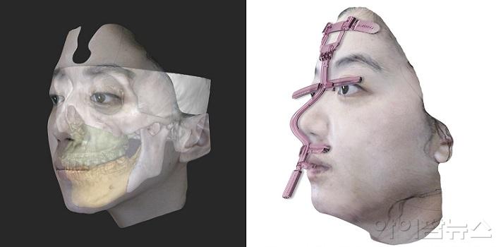 미얀마 여성의 수술에 사용된 3D 컴퓨터 시뮬레이션과 3D 프린팅.jpg