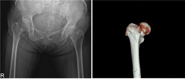 81세 여성의 우측 대퇴골 경부 골절 X선(왼쪽)과 CT(오른쪽) 영상.jpg
