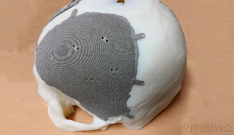 환자용 두개골에 맞춘 의료용 3D 프린팅 모델1 (1).jpg