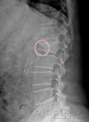 골다공증성 척추압박골절환자의 엑스레이 영상 (1).jpg