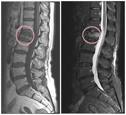 골다공증성 척추압박골절환자의 MRI 영상 (1).jpg