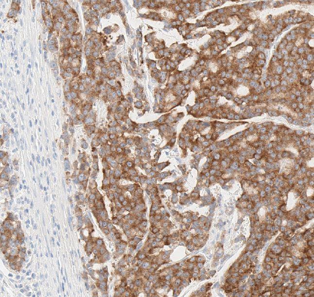 TRK 변이가 있는 대장암 조직의 단백질 발현 염색 이미지.jpg