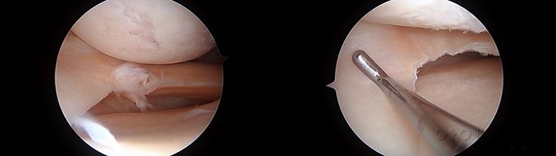 연골판부분절제술 전(왼쪽)과 후(오른쪽).jpg