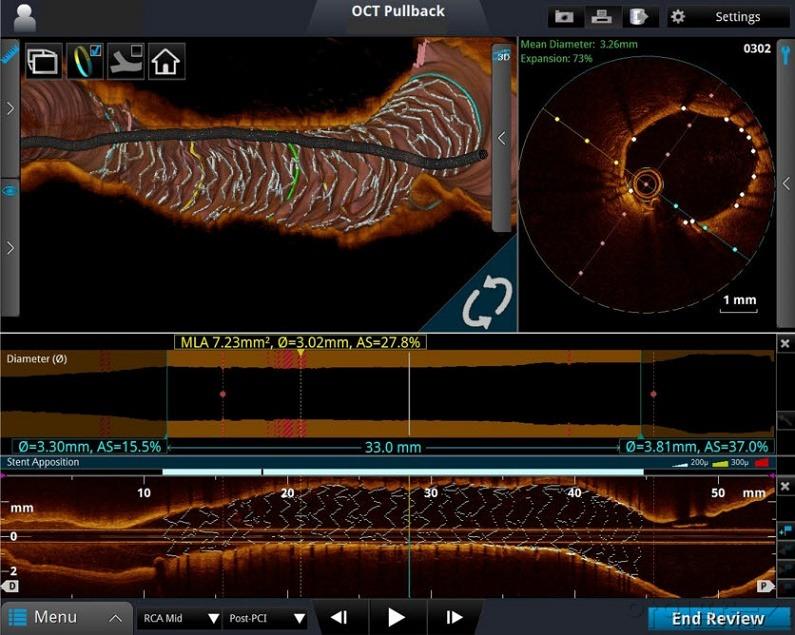 OCT를 이용한 심장혈관 스텐트 삽입술 영상 이미지.jpg